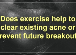 Exercise And Acne: The Complete Guide