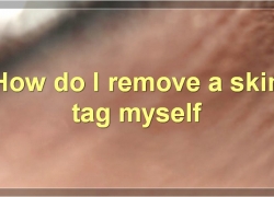 The Best Way To Remove A Skin Tag