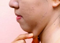 How to Lose Chin Fat