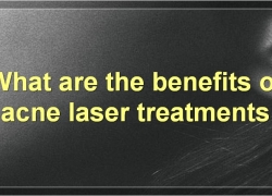 Acne Laser Treatment: Everything You Need To Know