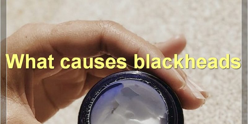 Everything You Need To Know About Blackheads